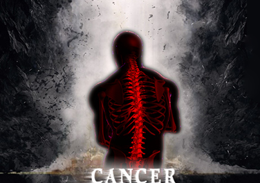 小心!这五大癌症容易骨转移